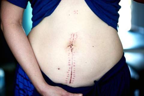 Abdominoplastika (pilvo plastika)