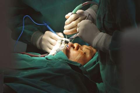 Blefaroplastika (akių vokų plastika)