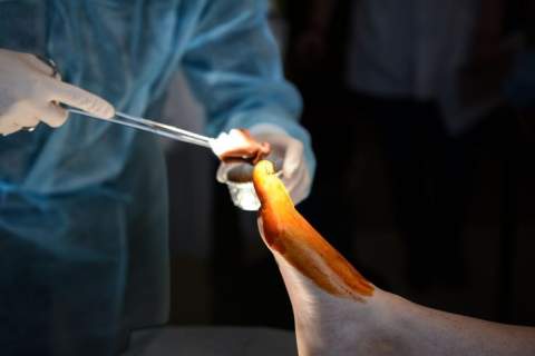 Hallux valgus operacija