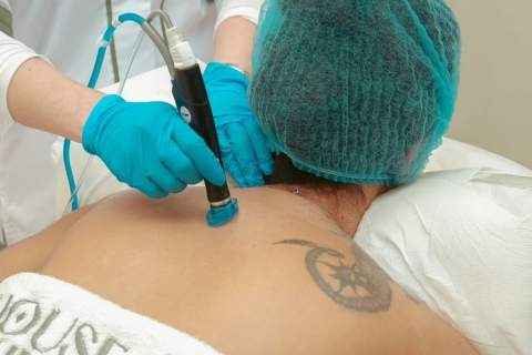 Lazerinis tatuiruočių šalinimas